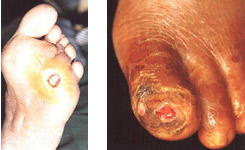 Llagas y úlceras - Pie diabético